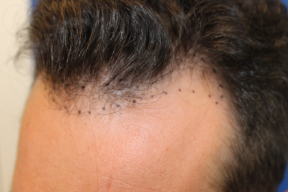 Hair Restoration Before & After Patient #6287