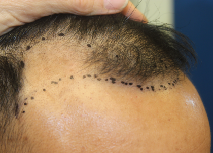 Hair Restoration Before & After Patient #6256