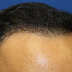 Hair Restoration Before & After Patient #6256