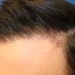 Hair Restoration Before & After Patient #6273