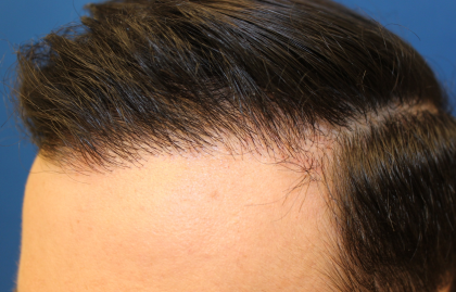 Hair Restoration Before & After Patient #6273