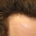 Hair Restoration Before & After Patient #6280