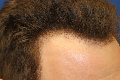 Hair Restoration Before & After Patient #6280