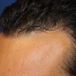 Hair Restoration Before & After Patient #6287