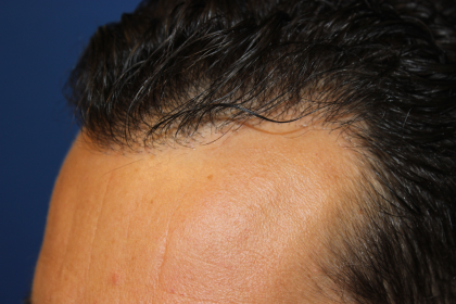 Hair Restoration Before & After Patient #6287