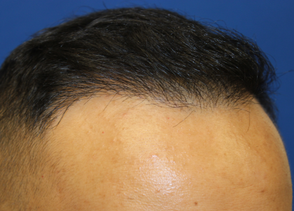 Hair Restoration Before & After Patient #6256