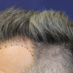 Hair Restoration Before & After Patient #6264