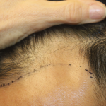 Hair Restoration Before & After Patient #6256