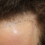 Hair Restoration Before & After Patient #6280