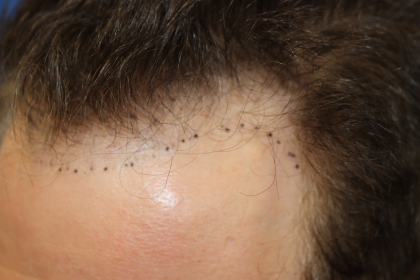 Hair Restoration Before & After Patient #6280