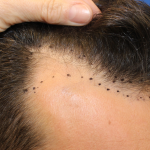 Hair Restoration Before & After Patient #6287