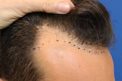 Hair Restoration Before & After Patient #6287