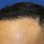 Hair Restoration Before & After Patient #6256