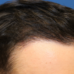 Hair Restoration Before & After Patient #6273