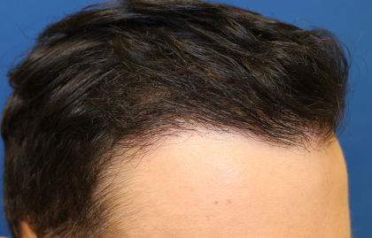 Hair Restoration Before & After Patient #6273