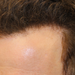 Hair Restoration Before & After Patient #6280