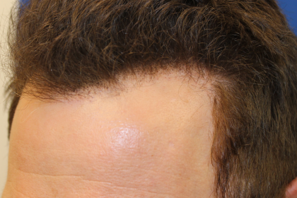 Hair Restoration Before & After Patient #6280