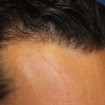 Hair Restoration Before & After Patient #6287