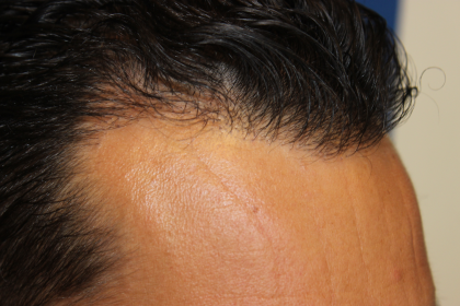 Hair Restoration Before & After Patient #6287