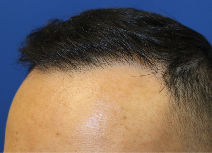 Hair Restoration Before & After Patient #6256