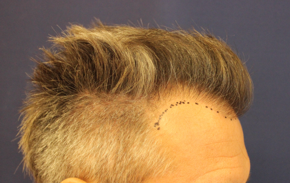 Hair Restoration Before & After Patient #6264