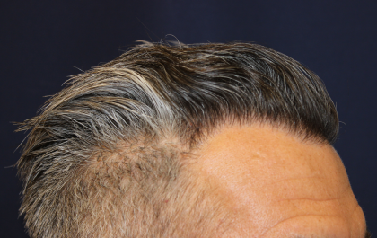 Hair Restoration Before & After Patient #6264