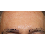 Eyebrows Before & After Patient #6250