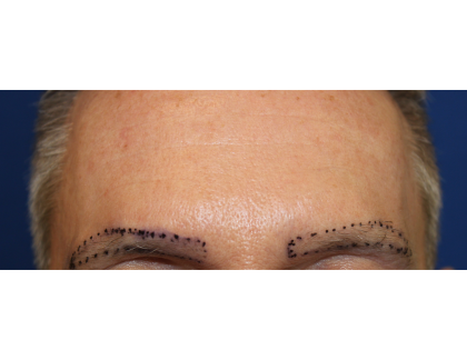 Eyebrows Before & After Patient #6250