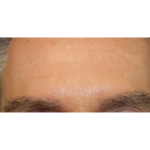 Eyebrows Before & After Patient #6250