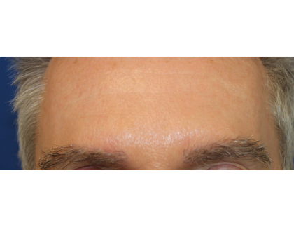 Eyebrows Before & After Patient #6250